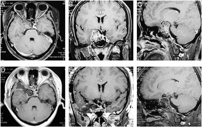 Pretemporal Transcavernous Approach for Resection of Non-meningeal Tumors of the Cavernous Sinus: Single Center Experience